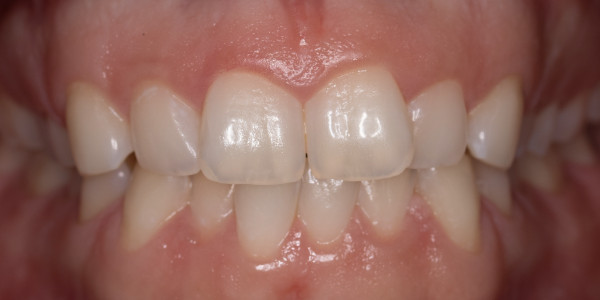 Лечение на струпване в горна и долна челюст с алайнери