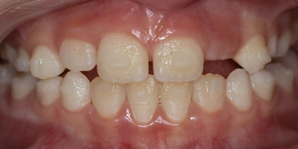 Лечение на кръстосана захапка в страничен участък при дете на 7 години