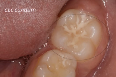 Силанизиране на зъби